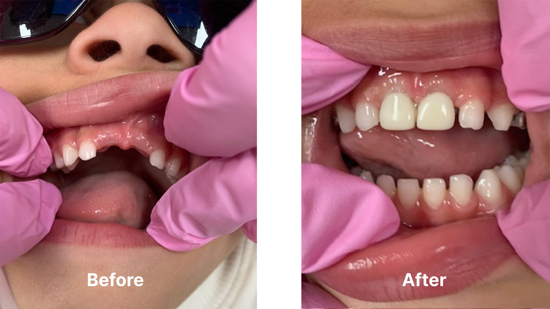 Pediatric Partial Denture Dentist In Bethesda Md